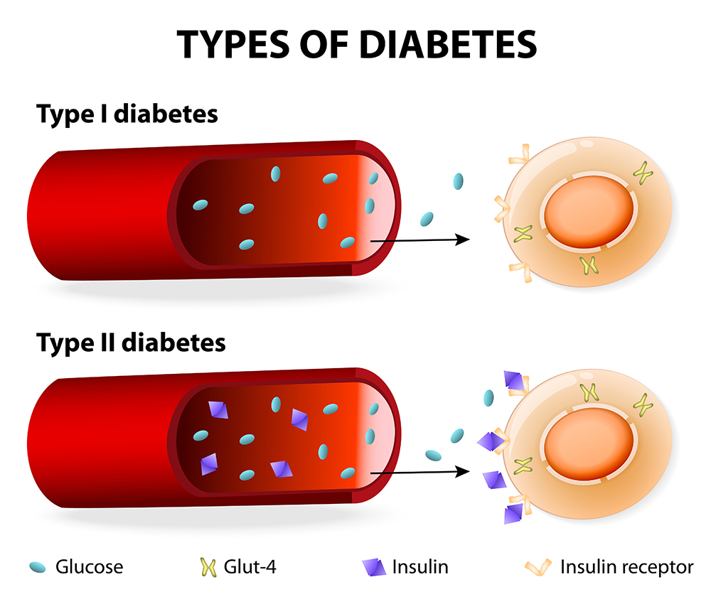 بیماری دیابت, کنترل قند خون, انسولین, غده پانکراس, دیابت