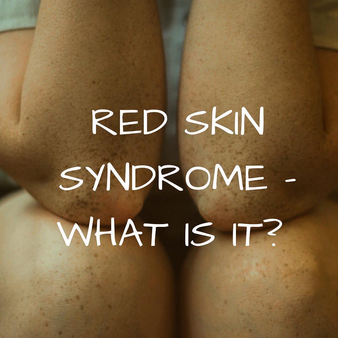 سندرم پوست قرمز, اعتیاد موضعی استروئیدی, مشکلات پوستی, اگزمای شدید